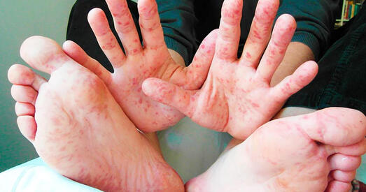 Ва Украіне ўспышка адру: за тыдзень захварэлі больш за 1400 чалавек